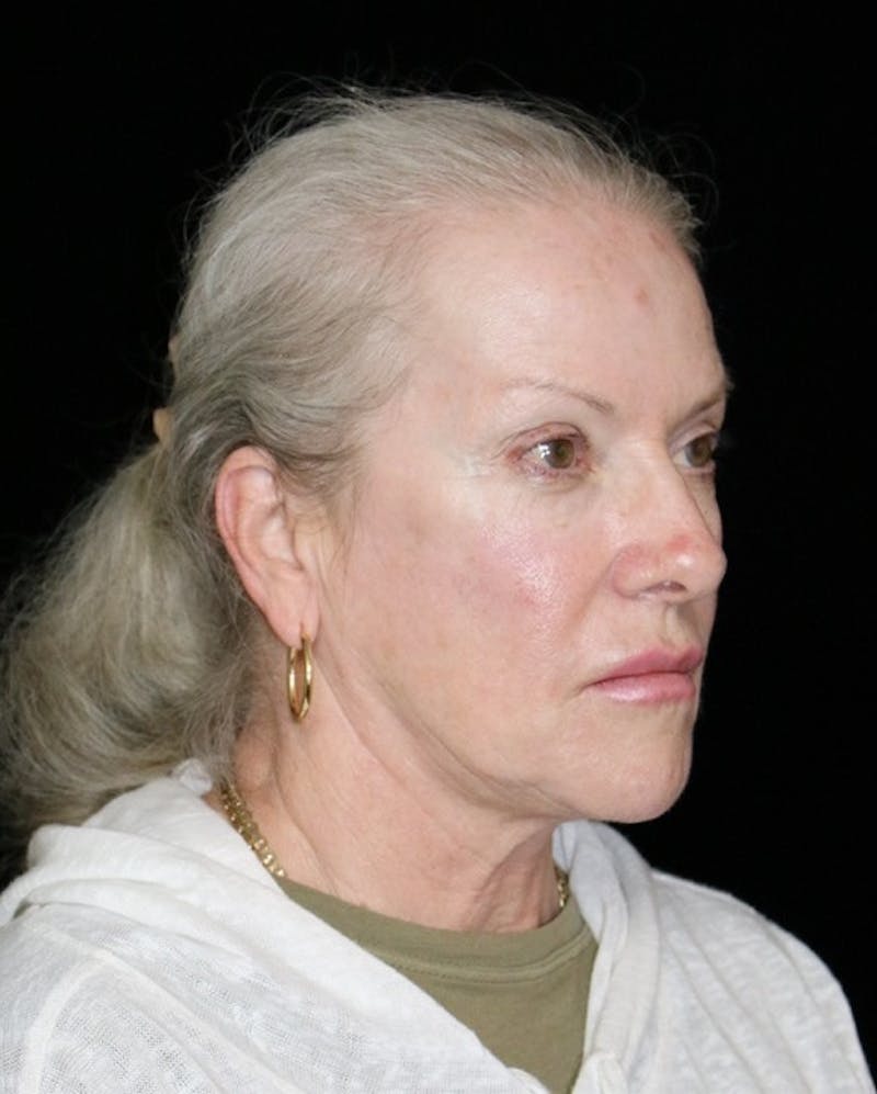 Facelift Before & After Gallery - Patient 707484 - Image 3