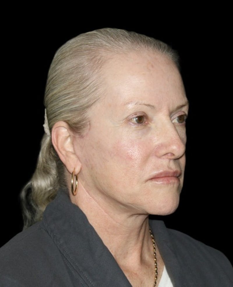 Facelift Before & After Gallery - Patient 707484 - Image 4