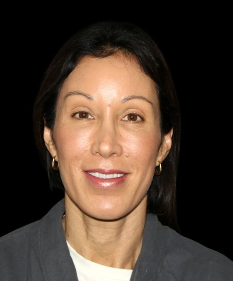 Facial Fat Grafting Before & After Gallery - Patient 392068 - Image 3