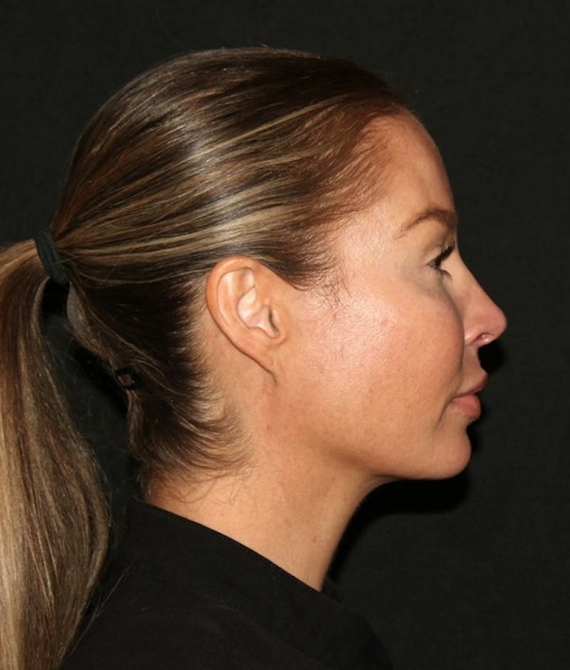 Facial Fat Grafting Before & After Gallery - Patient 430084 - Image 12