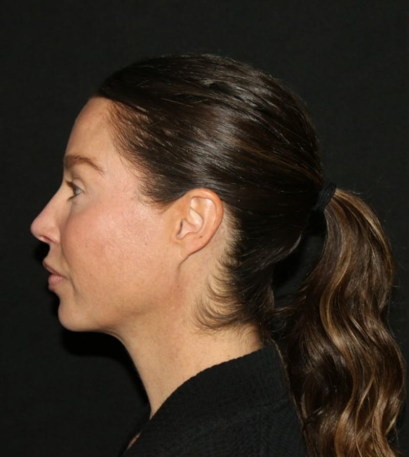 Facial Fat Grafting Before & After Gallery - Patient 430084 - Image 9