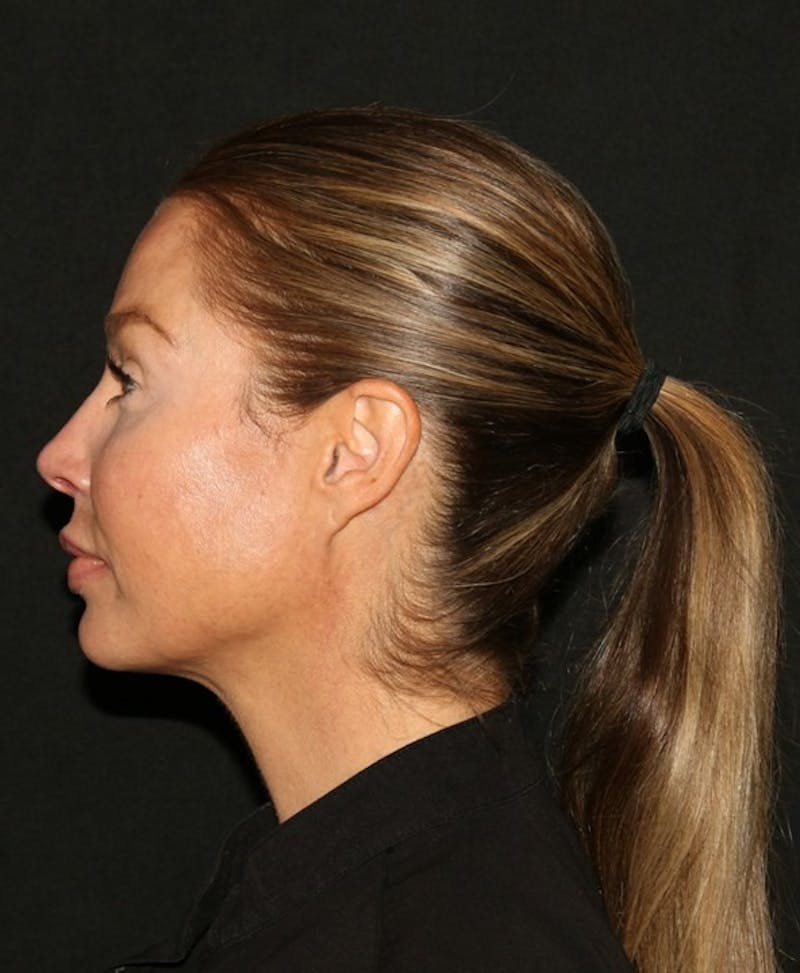 Facial Fat Grafting Before & After Gallery - Patient 430084 - Image 10