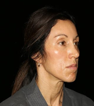 Facial Fat Grafting Before & After Gallery - Patient 392068 - Image 8
