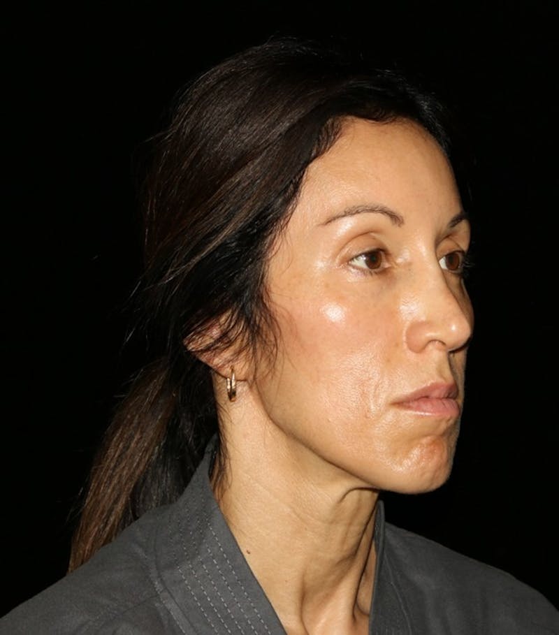 Facial Fat Grafting Before & After Gallery - Patient 392068 - Image 8