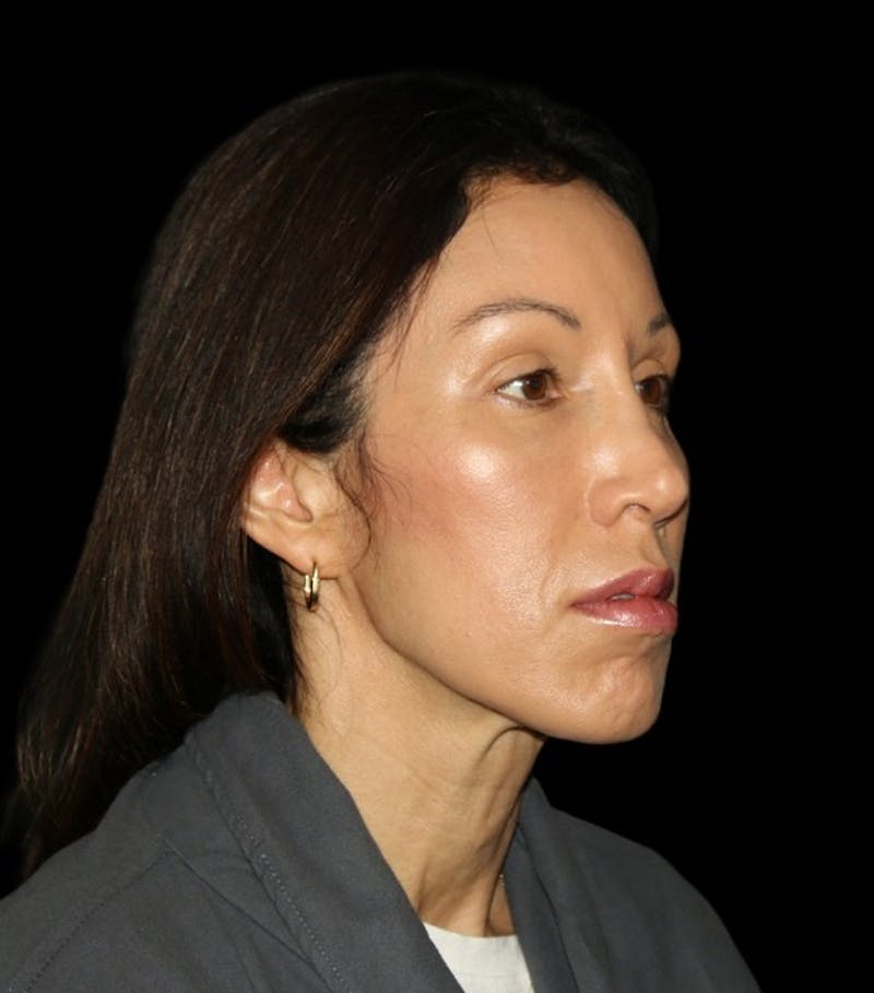 Facial Fat Grafting Before & After Gallery - Patient 392068 - Image 9