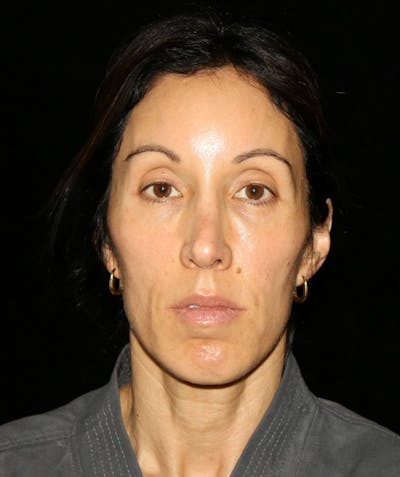 Facial Fat Grafting Before & After Gallery - Patient 392068 - Image 1