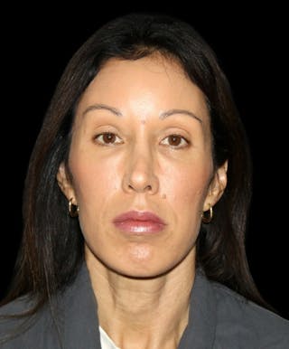 Facial Fat Grafting Before & After Gallery - Patient 392068 - Image 2