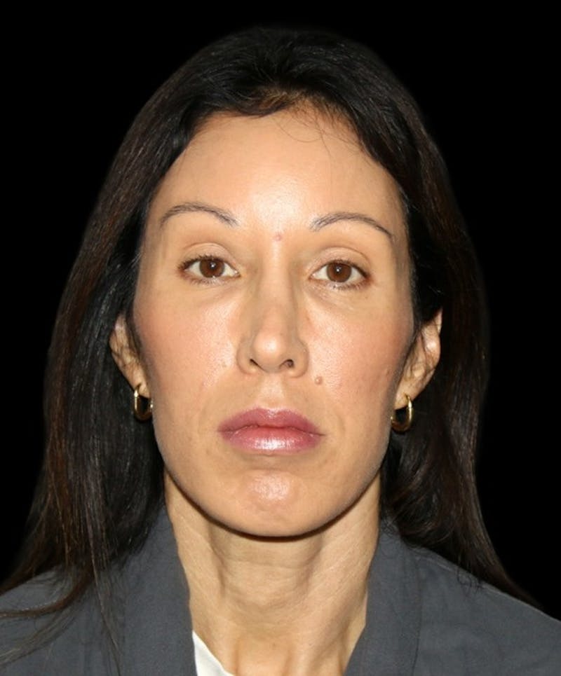 Facial Fat Grafting Before & After Gallery - Patient 392068 - Image 2