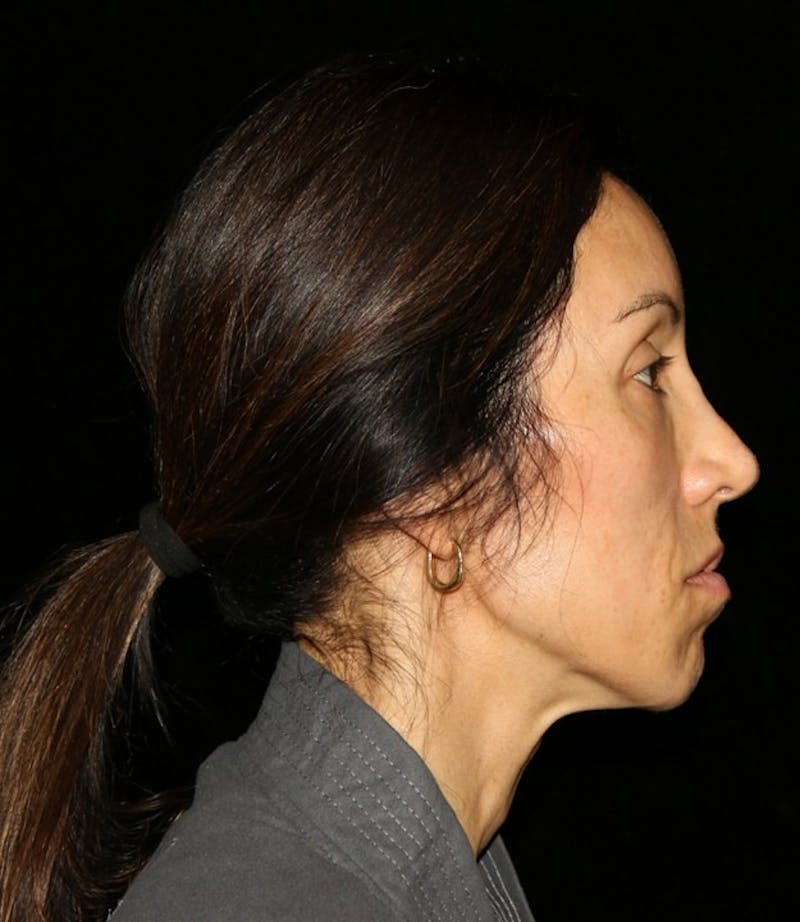 Facial Fat Grafting Before & After Gallery - Patient 392068 - Image 6