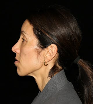 Facial Fat Grafting Before & After Gallery - Patient 392068 - Image 4