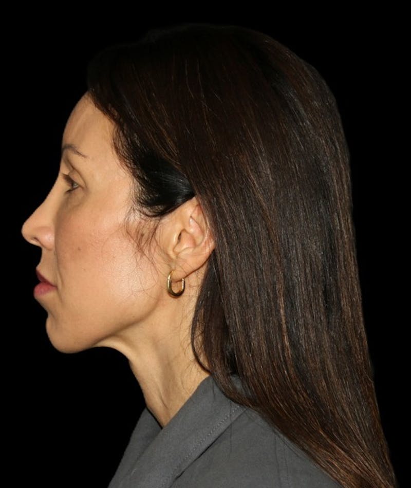 Facial Fat Grafting Before & After Gallery - Patient 392068 - Image 5