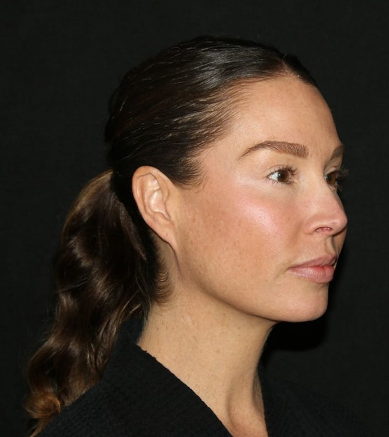 Facial Fat Grafting Before & After Gallery - Patient 430084 - Image 7