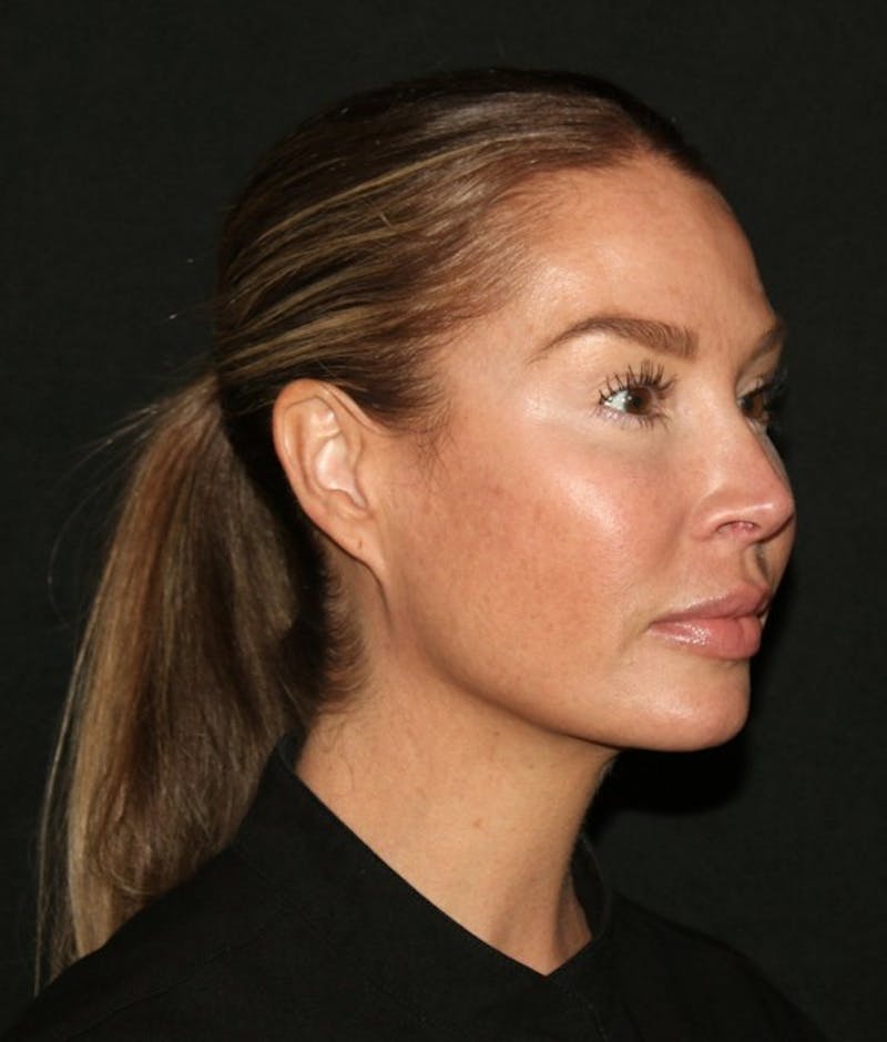 Facial Fat Grafting Before & After Gallery - Patient 430084 - Image 8