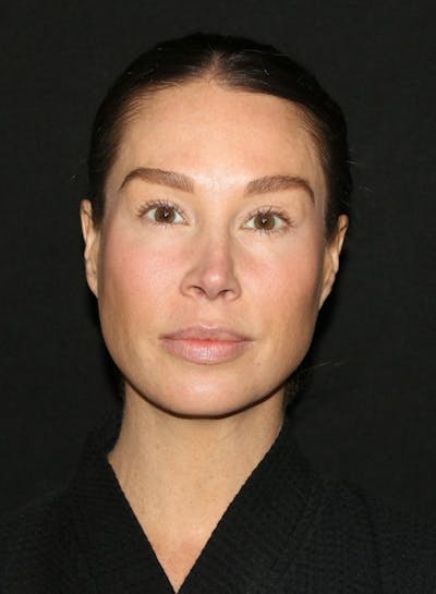 Facial Fat Grafting Before & After Gallery - Patient 430084 - Image 1