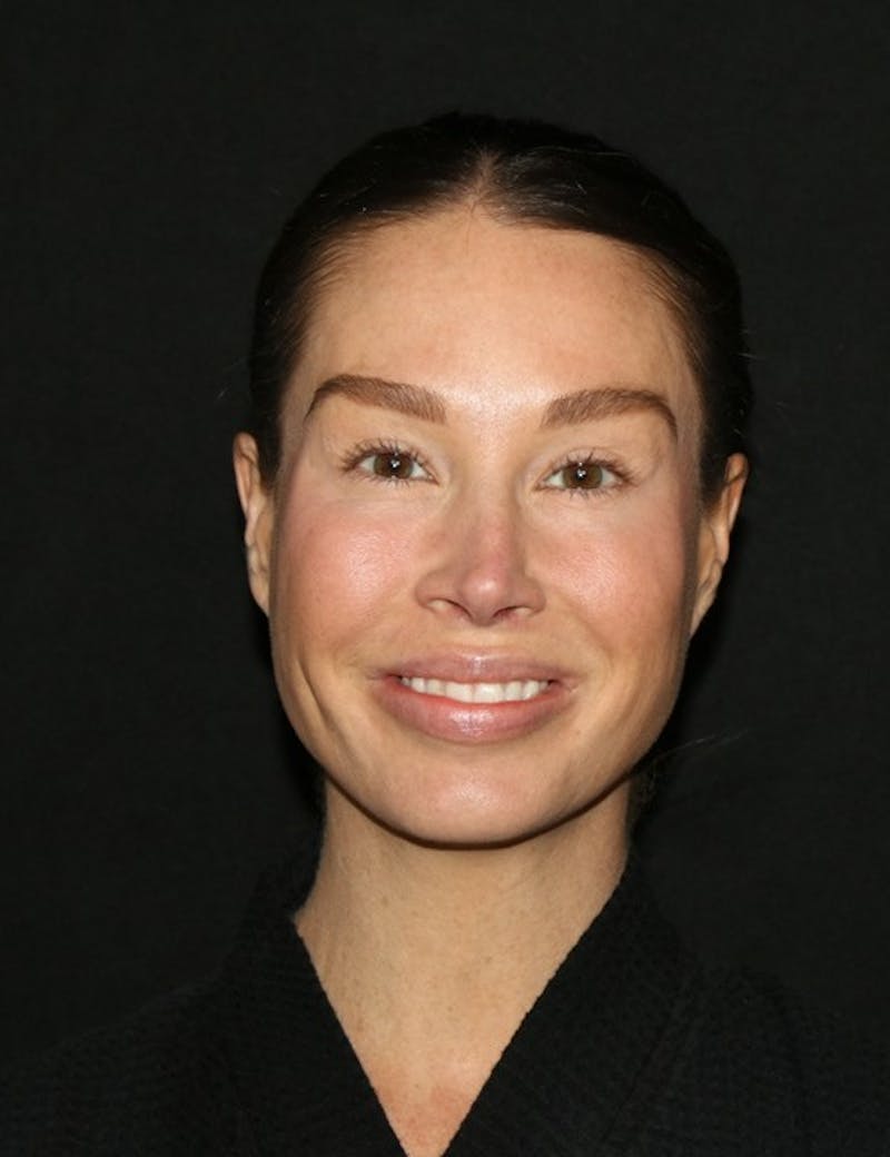 Facial Fat Grafting Before & After Gallery - Patient 430084 - Image 3
