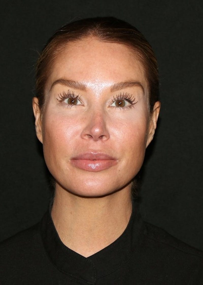 Facial Fat Grafting Before & After Gallery - Patient 430084 - Image 2