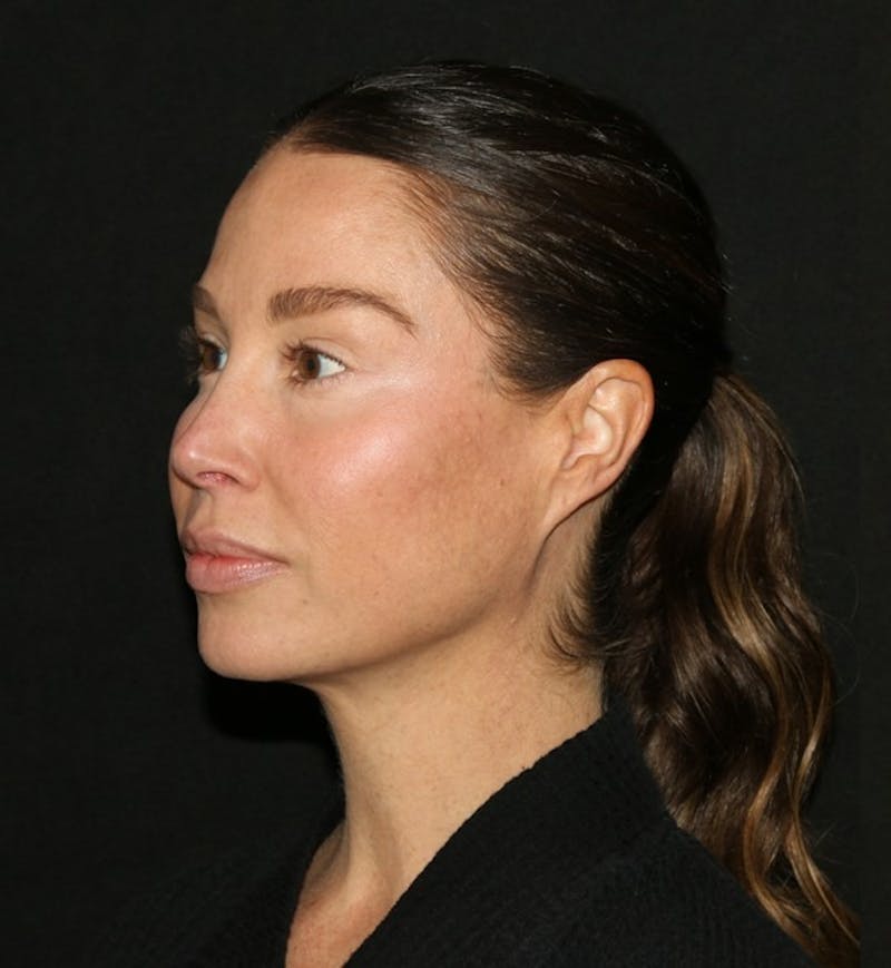Facial Fat Grafting Before & After Gallery - Patient 430084 - Image 5