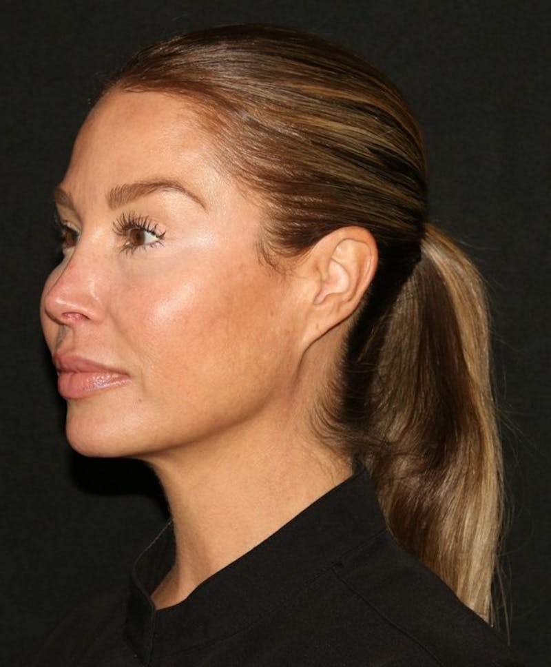 Facial Fat Grafting Before & After Gallery - Patient 430084 - Image 6