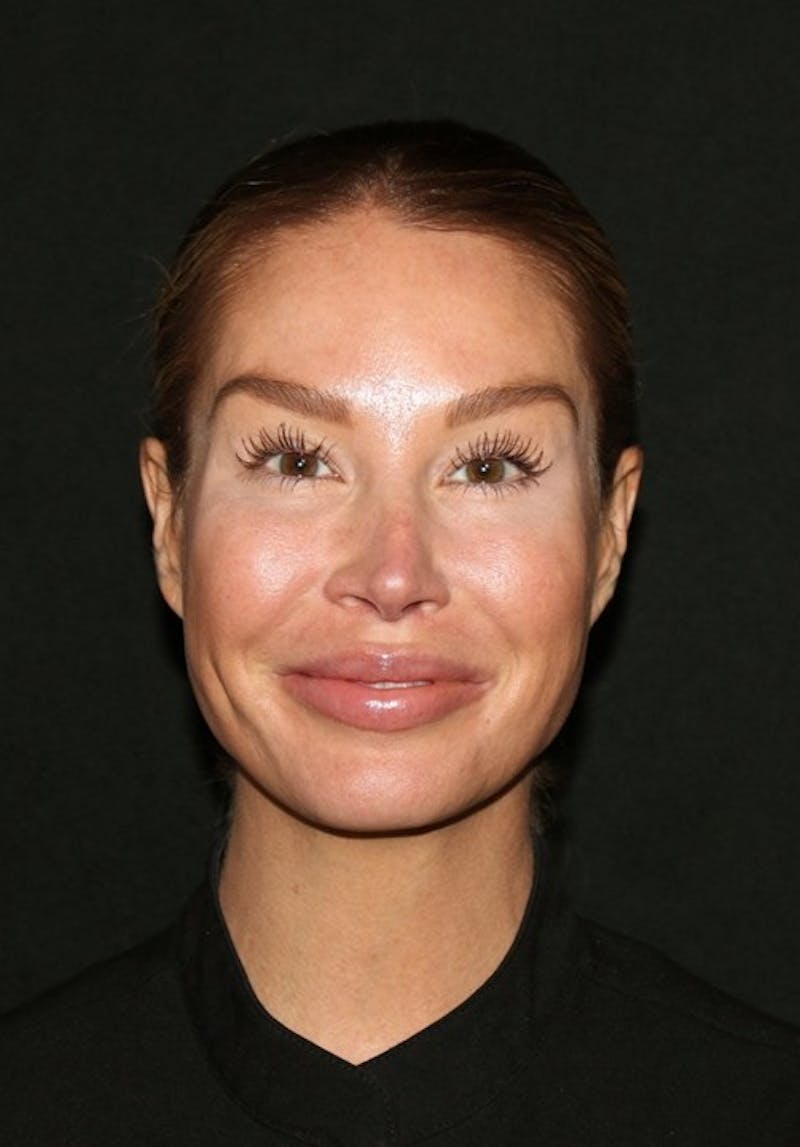 Facial Fat Grafting Before & After Gallery - Patient 430084 - Image 4