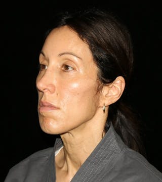 Facial Fat Grafting Before & After Gallery - Patient 392068 - Image 10