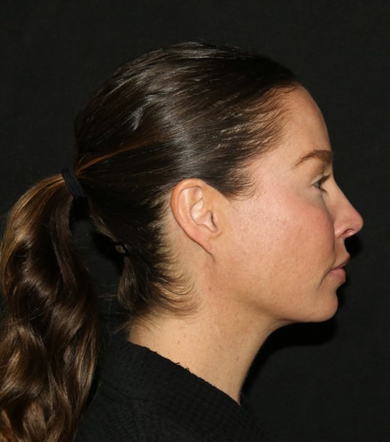 Facial Fat Grafting Before & After Gallery - Patient 430084 - Image 11