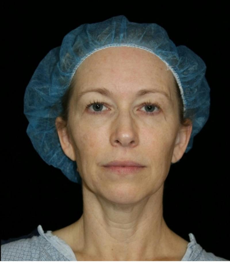 Blepharoplasty Before & After Gallery - Patient 279169 - Image 1