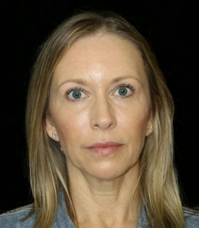 Blepharoplasty Before & After Gallery - Patient 279169 - Image 2