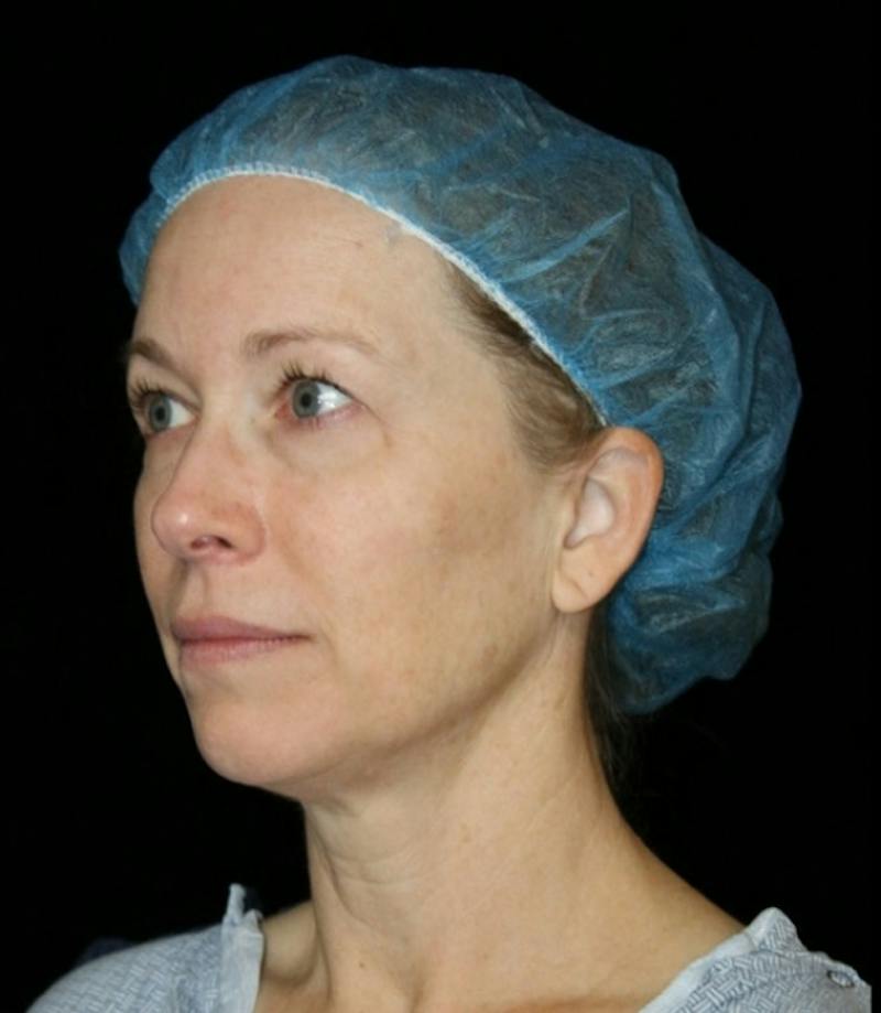 Blepharoplasty Before & After Gallery - Patient 279169 - Image 3