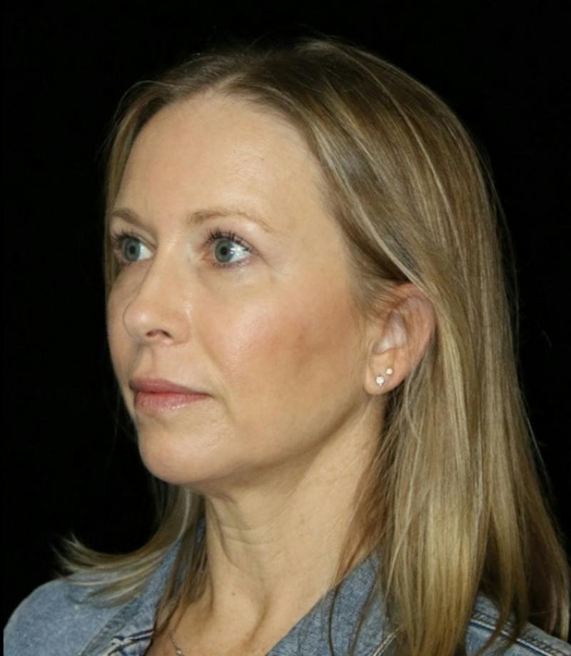 Blepharoplasty Before & After Gallery - Patient 279169 - Image 4