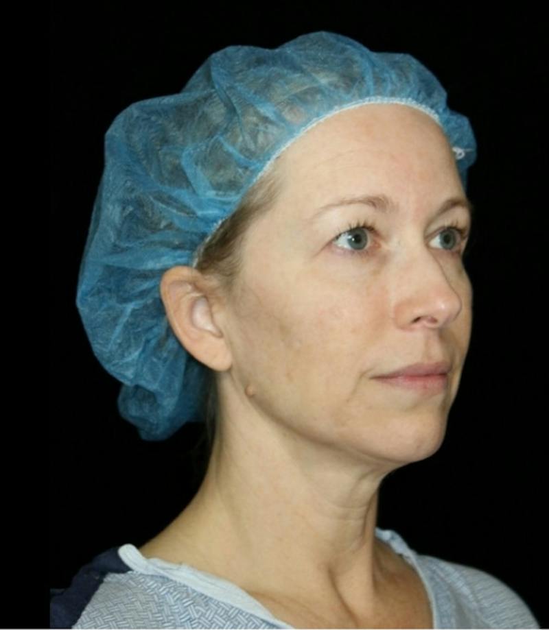 Blepharoplasty Before & After Gallery - Patient 279169 - Image 5