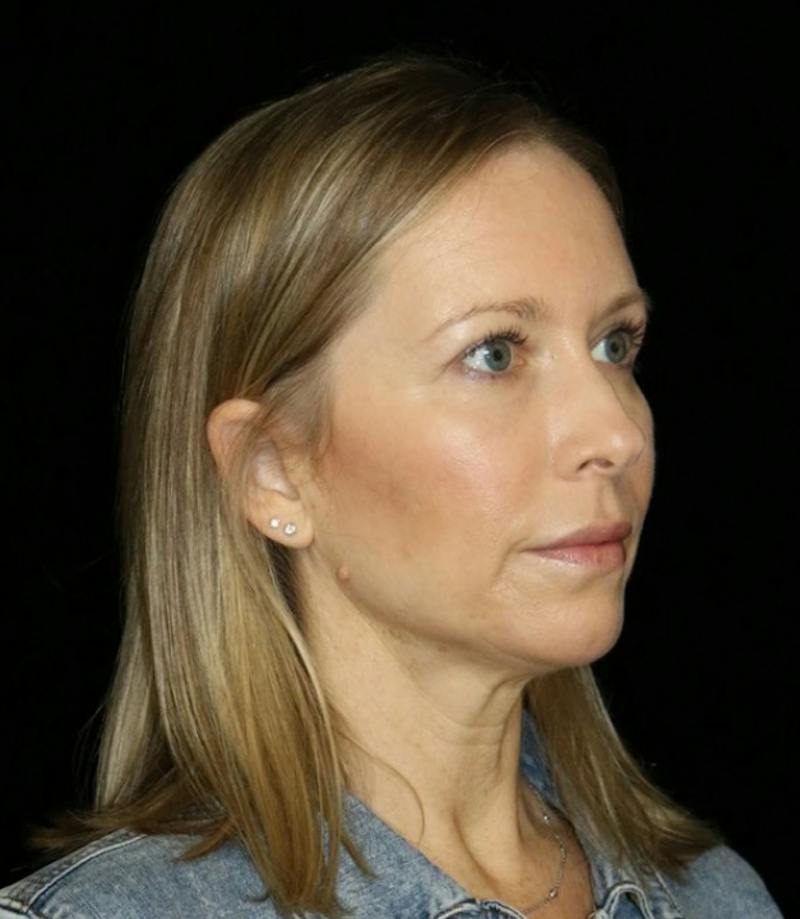 Blepharoplasty Before & After Gallery - Patient 279169 - Image 6