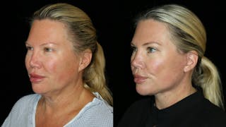 Blepharoplasty Before & After Gallery - Patient 310289 - Image 2