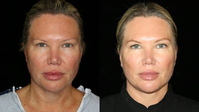 Blepharoplasty Before & After Gallery - Patient 310289 - Image 1