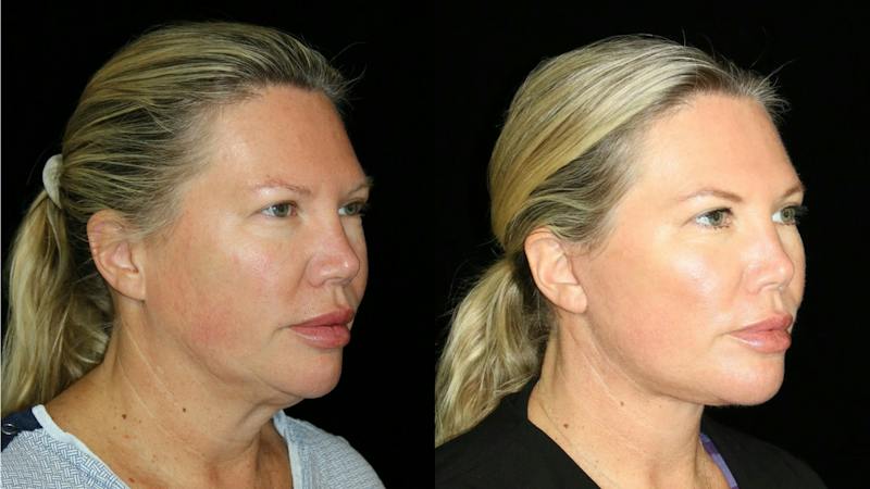 Blepharoplasty Before & After Gallery - Patient 310289 - Image 3