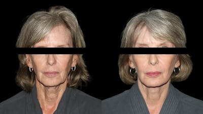 Brow Lift Before & After Gallery - Patient 575210 - Image 1