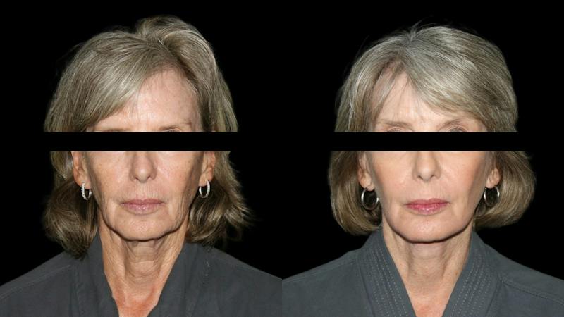 Brow Lift Before & After Gallery - Patient 575210 - Image 1