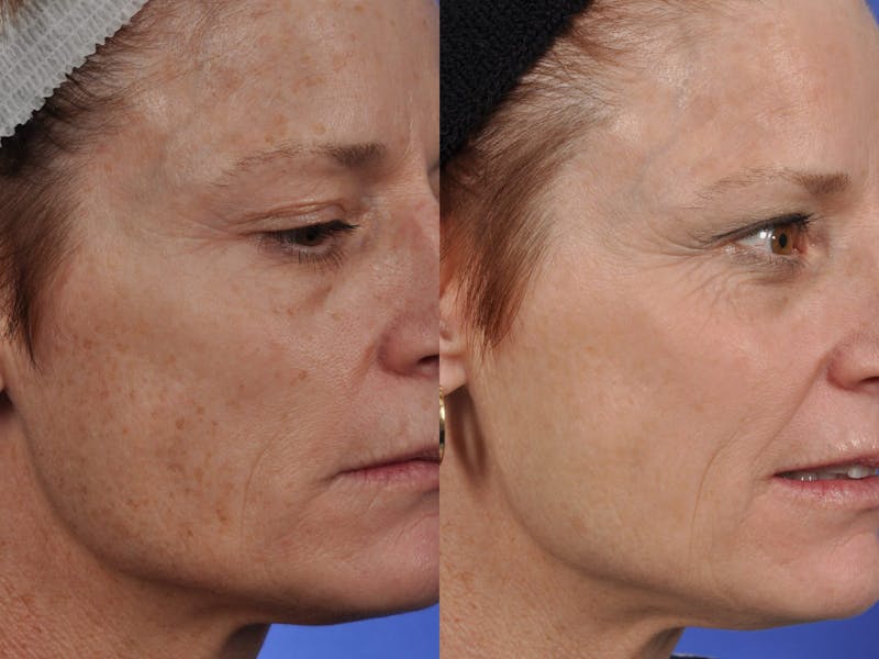Before and after photos