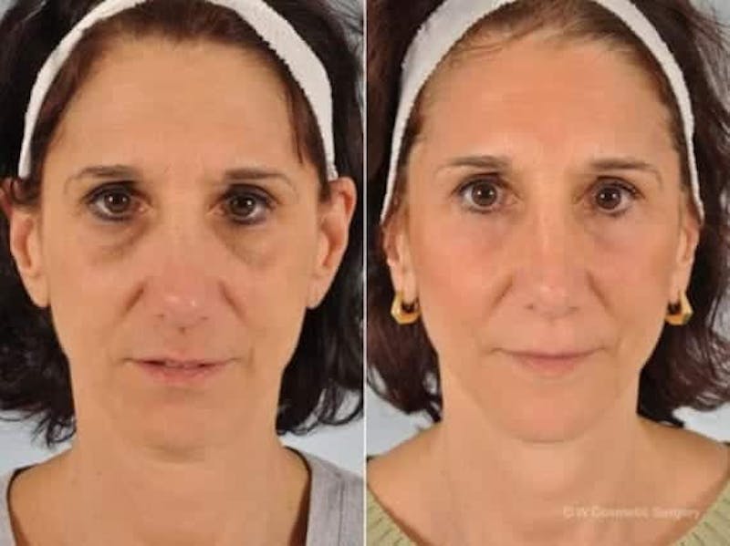 Restylane B&As