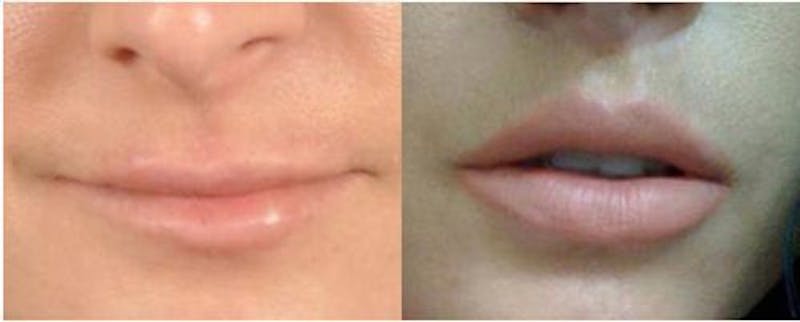 Lip lift B&A photos