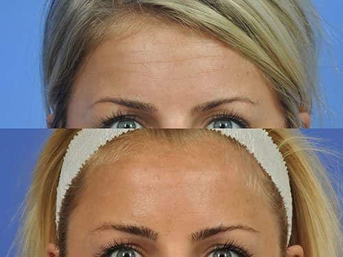 Botox Beginnings – How I Became a Botox Believer - W Cosmetic Surgery®