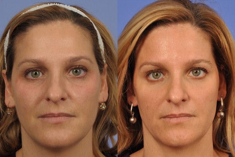 Female patient after a skin treatment