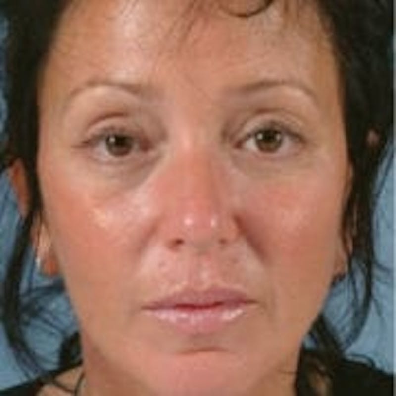 A woman after a facelift
