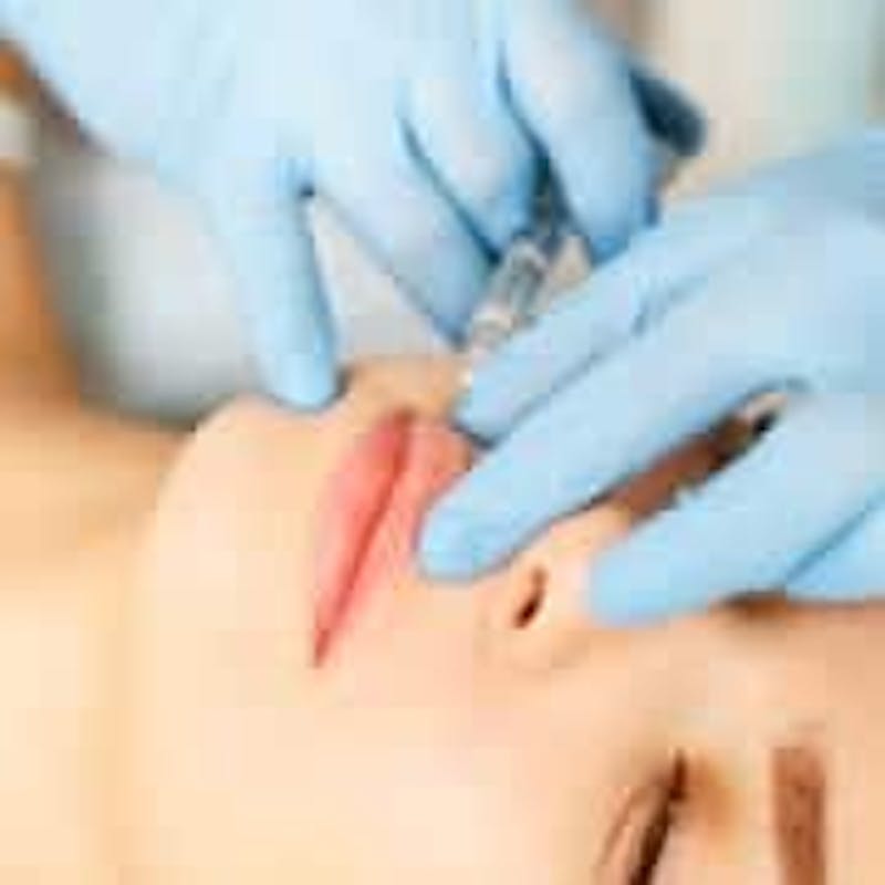 A woman getting lip filler