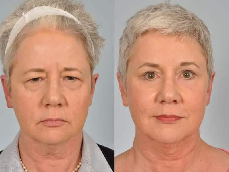 Micromidfacelift B&As