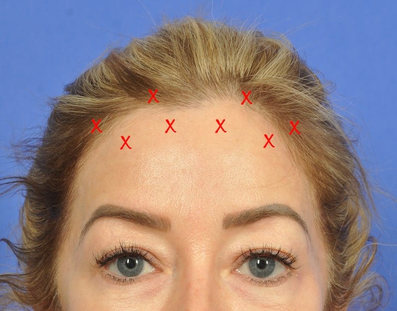 The BOTOX® Brow Lift Revisited - W Cosmetic Surgery®