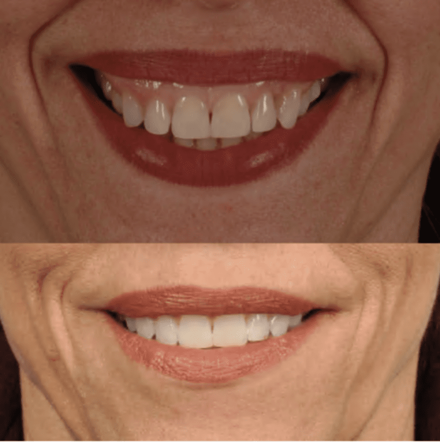 Botox lip flip B&A photos