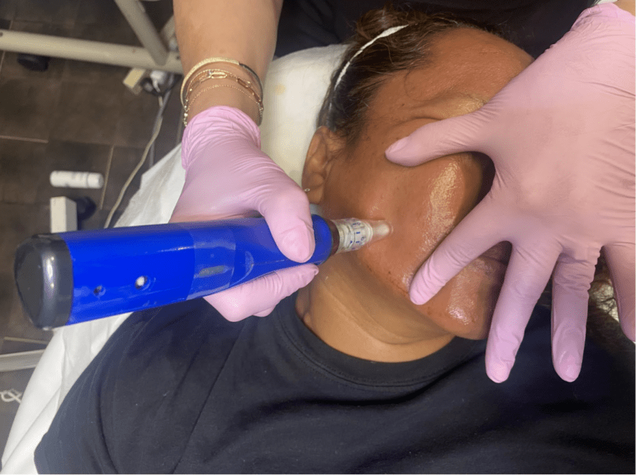 A woman getting microneedling