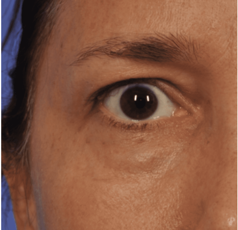 patient with festoon