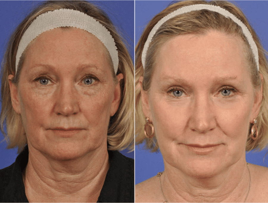 Laser Skin Resurfacing B&As