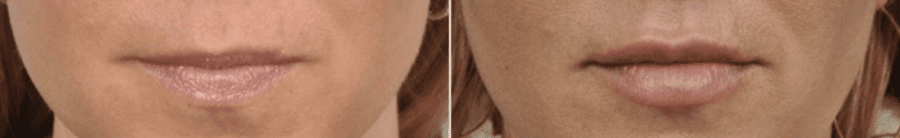 Lip filler B&A photos